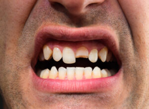 Cracked Teeth Henfield
