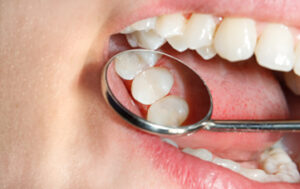 Dental Fillings Henfield