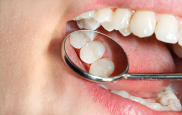 Dental Fillings Henfield